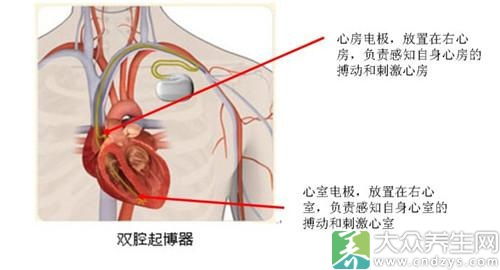 idc起搏器适应症,ICD起搏器适应症