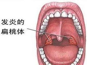 扁桃体长在什么位置图