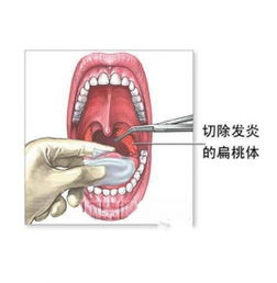 扁桃体切除手术价格，扁桃体切割手术多少钱