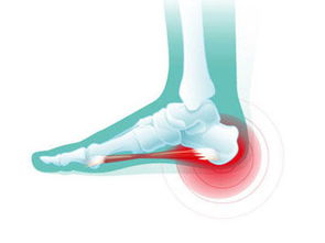 脚后跟痛如何治疗效果好?出现跟骨骨刺怎么