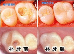 纳米树脂补牙和3m树脂补牙的区别