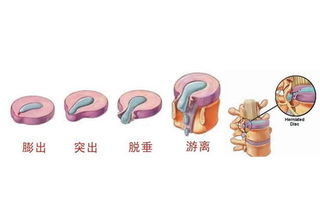 椎间盘向后突出是什么意思，l4/5,l5/s1椎间盘突出是什么意思